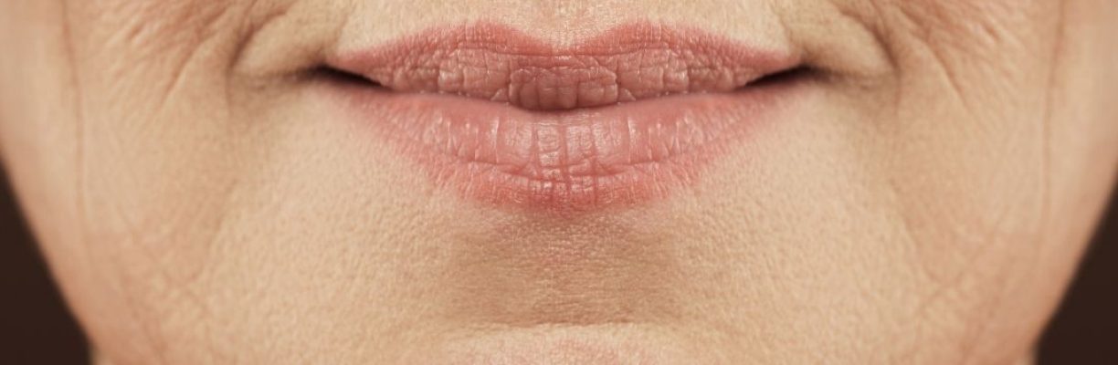 Belotero for Lip Lines A Clinical Overview for Providers